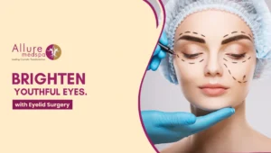 Eyelid surgery 300x170 1