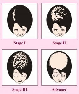 Female Pattern Baldness 252x300 1