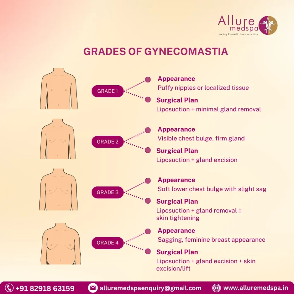 Grades of Gynecomastia 1