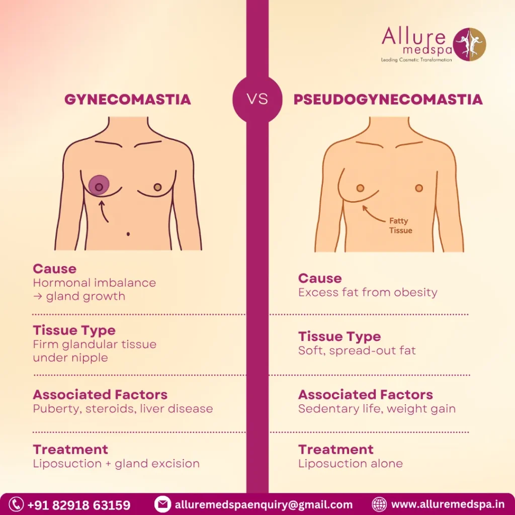 Key Differences Between Gynecomastia and Pseudogynecomastia 1