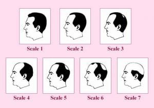 Male Pattern Baldness 300x212 1