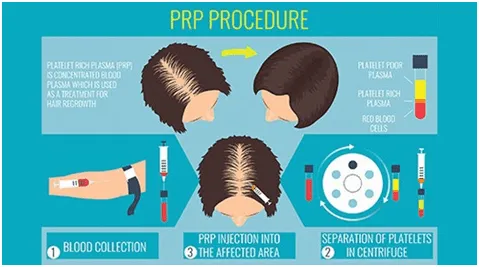 PRP Treatment in Mumbai India 1