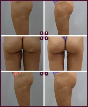 Allure_Liposuction_Thaigh_Thin_2021-4