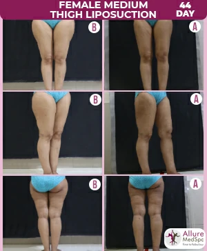 Female_Medium_Thigh_Liposuction